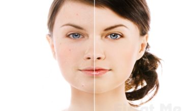 Leke tedavisi 2016 yöntemleri